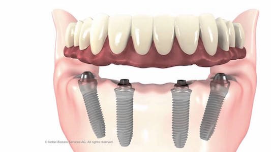 Vertex Thermosens Dentures Hartville OH 44632